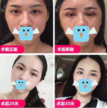 <!--<i data=20240710 data-id=11888></i>-->黄印资双眼皮术后1个月恢复过程图 <!--<i data=20240710 data-id=11888></i>-->黄印资双眼皮术后1个月恢复过程图