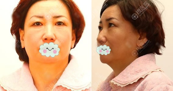 今天要去北京华韩美容医院复查,做全面部拉皮提升手术3个月了