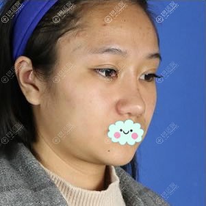 我找北京艺兴医疗美容医院谷亦涵做面部线雕提升恢复童颜日记