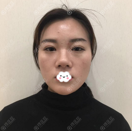用我的肋软骨隆鼻经历告诉你南京华韩奇致裴柄万做鼻子怎么样