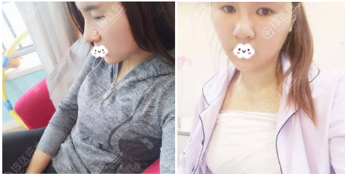 除了吸脂手术之外,成都艾米丽潘红伟做的假体隆胸效果也很不错
