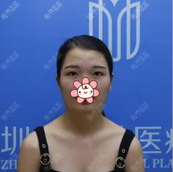 我这么美就是在深圳美加美做了芭比眼综合又找李莉玻尿酸丰下巴