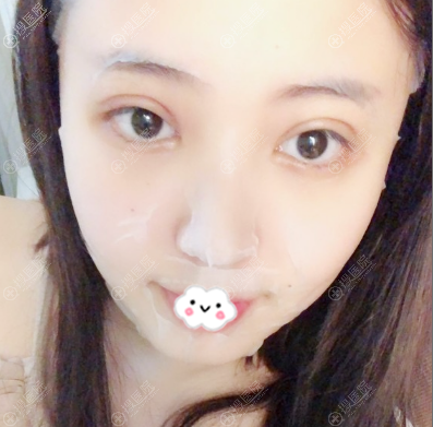 全切双眼皮术后5天效果图 全切双眼皮术后5天效果图