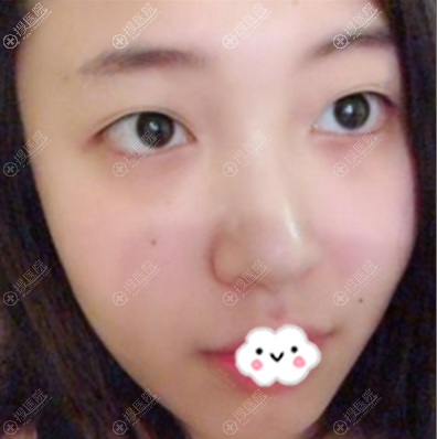在大连爱德丽格做双眼皮术前照片 在大连爱德丽格做双眼皮术前照片