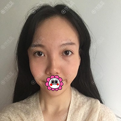到广州名韩做自体脂肪全脸填充改善面部凹陷后变得年轻又漂亮