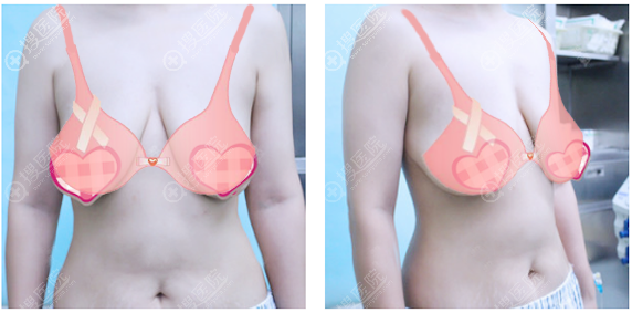 公开我花8万元找济南韩氏郭广科做人工韧带乳房上提恢复过程图