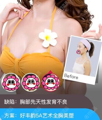 广州曙光艺术丰胸对比效果 广州曙光艺术丰胸对比效果
