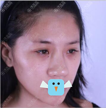 我好崇拜给我做了缩鼻翼的深圳美莱韩先奎医生,鼻综合效果好棒