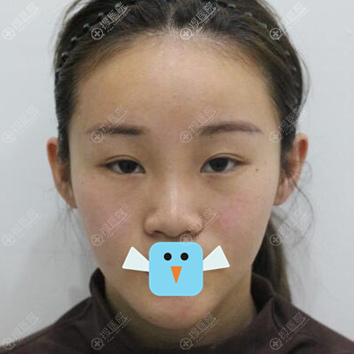 韩国清潭FIRST李丙玟双眼皮鼻综合整形案例分享术后对比效果图