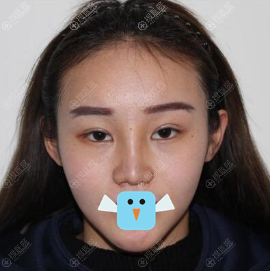 清潭FIRST李丙玟立体旋翼鼻术后效果图 清潭FIRST李丙玟立体旋翼鼻术后效果图