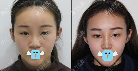 清潭FIRST李丙玟双眼皮鼻综合术后对比效果图 清潭FIRST李丙玟双眼皮鼻综合术后对比效果图
