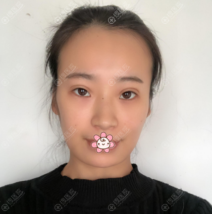 找上海韩镜任钟赫做完脂肪填充后不仅脸型饱满了皮肤也变水嫩了