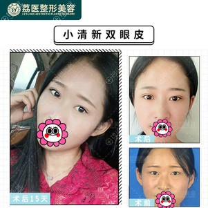 广州荔医双眼皮对比效果 广州荔医双眼皮对比效果