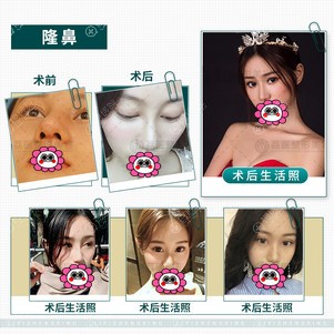 广州荔医隆鼻恢复过程图 广州荔医隆鼻恢复过程图