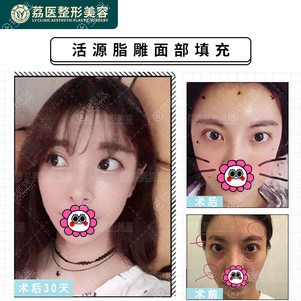 广州荔医脂肪填充对比案例 广州荔医脂肪填充对比案例