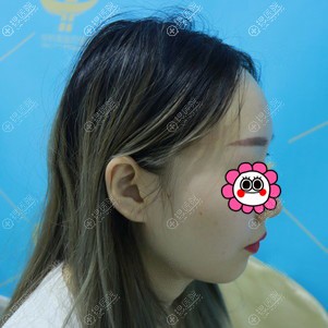 假体垫下巴后悔了?分享我到广州中科美找邓咏做的硅胶垫下巴