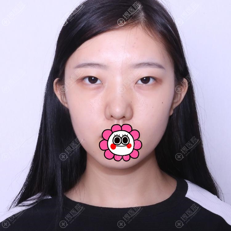 广州曙光割双眼皮好吗?揭晓王娟做的双眼皮和玻尿酸填泪沟案例