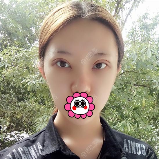 双眼皮术后一周到医院拆线 双眼皮术后一周到医院拆线