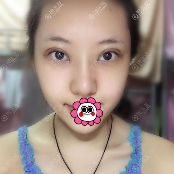 双眼皮术后一个月恢复效果 双眼皮术后一个月恢复效果