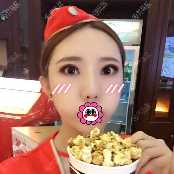 广州曙光王娟做双眼皮术后恢复三个月效果 广州曙光王娟做双眼皮术后恢复三个月效果