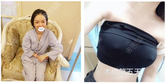 找上海伊莱美李湘原做完鼻子后我又去找江华教授做了假体隆胸