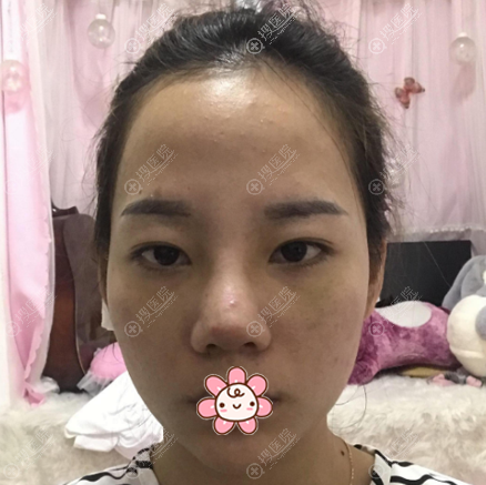看了上海仁爱医院刘先超的隆鼻案例后决定找他为我做鼻综合隆鼻