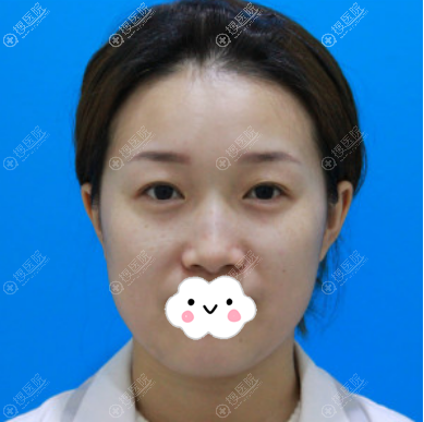 去沈阳元辰做眼睛前照片 去沈阳元辰做眼睛前照片