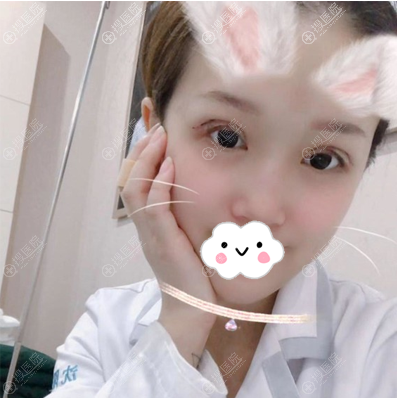 沈阳元辰连圆圆生态双眼皮术后第二天 沈阳元辰连圆圆生态双眼皮术后第二天