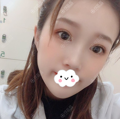 沈阳元辰连圆圆双眼皮真实案例效果图 沈阳元辰连圆圆双眼皮真实案例效果图