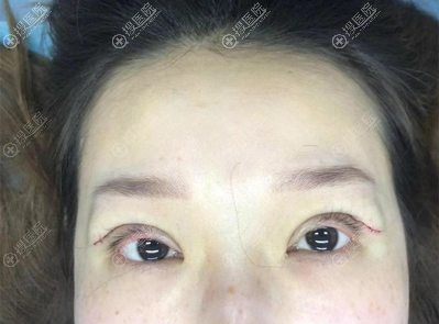 沈阳元辰连圆圆双眼皮术后即刻照片 沈阳元辰连圆圆双眼皮术后即刻照片