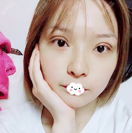 双眼皮眼综合术后8天自拍照片 双眼皮眼综合术后8天自拍照片