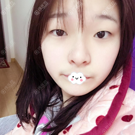 在<!--<i data=20240710 data-id=11912></i>-->医疗美容医院做双眼皮术前照片 在<!--<i data=20240710 data-id=11912></i>-->医疗美容医院做双眼皮术前照片
