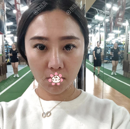 打听到上海薇琳张怀军做鼻子很靠谱就找他做了隆鼻修复和双眼皮