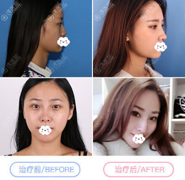 <!--<i data=20240710 data-id=12045></i>-->罗志敏鼻综合术后效果 <!--<i data=20240710 data-id=12045></i>-->罗志敏鼻综合术后效果