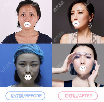 <!--<i data=20240710 data-id=12045></i>-->超皮秒祛斑效果展示 <!--<i data=20240710 data-id=12045></i>-->超皮秒祛斑效果展示