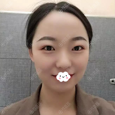 几经对比觉得西安傲丽正规靠谱找王爱武院长做双眼皮后获美人眼
