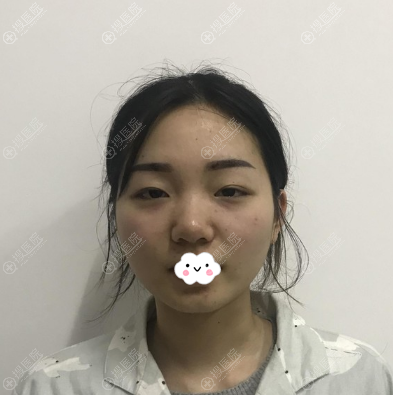 肉肉脸女生找杭州美联致美贾东宇做了埋线提升不但瘦脸还减龄
