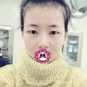 在赤峰丽都找潘福强院长做全切双眼皮手术价格合理效果好
