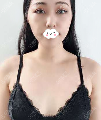 没想到在西安画美做了自体脂肪丰胸能达到丰胸瘦腿两重效果