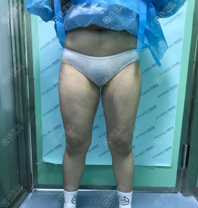 <!--<i data=20240710 data-id=12089></i>-->于兆松大腿吸脂术前照片 <!--<i data=20240710 data-id=12089></i>-->于兆松大腿吸脂术前照片