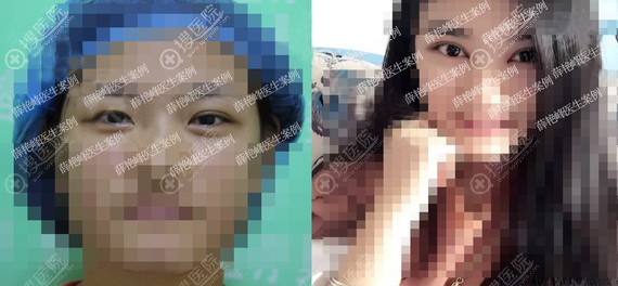 ��������Ѧ�޷�˫��Ƥ�޸�����ָ��Ա�Ч��