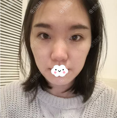 找韩国碧夏整形医院李珉仕(奭)院长做双眼皮隆鼻只为相亲不将就