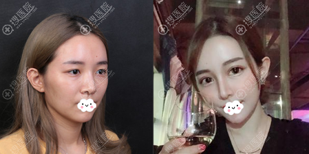 深圳美莱林登文双眼皮术后生活照 深圳美莱林登文双眼皮术后生活照