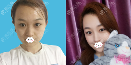 深圳丽港丽格谢俊硅胶隆鼻术后美照 深圳丽港丽格谢俊硅胶隆鼻术后美照