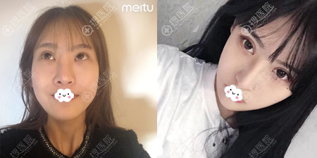 深圳润泽瑞尼丝刘庚肋软骨隆鼻术前术后对比照 深圳润泽瑞尼丝刘庚肋软骨隆鼻术前术后对比照