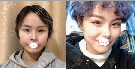深圳京韩兰茂梵美乔爱军全面部脂肪填充案例 深圳京韩兰茂梵美乔爱军全面部脂肪填充案例
