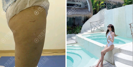 深圳富华斯良洪大腿吸脂案例 深圳富华斯良洪大腿吸脂案例