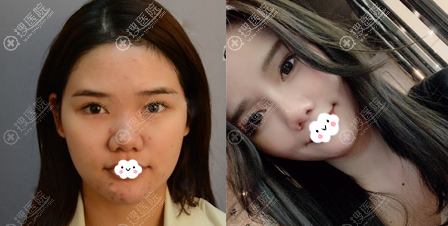 <!--<i data=20240710 data-id=12045></i>-->罗志敏鼻综合术后对比图 <!--<i data=20240710 data-id=12045></i>-->罗志敏鼻综合术后对比图