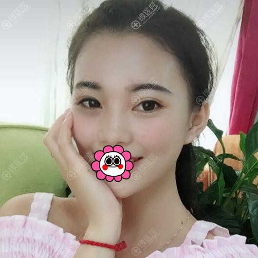 到潍坊天宏找薛提朋做隆鼻只因头次注射玻尿酸没有达到预期效果