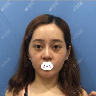 找南京美贝尔张永升做肋软骨隆鼻+全脸脂肪填充这变化也太大了
